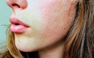 winter skin problems and cure